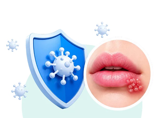 Ilustrasi Herpes Simplex